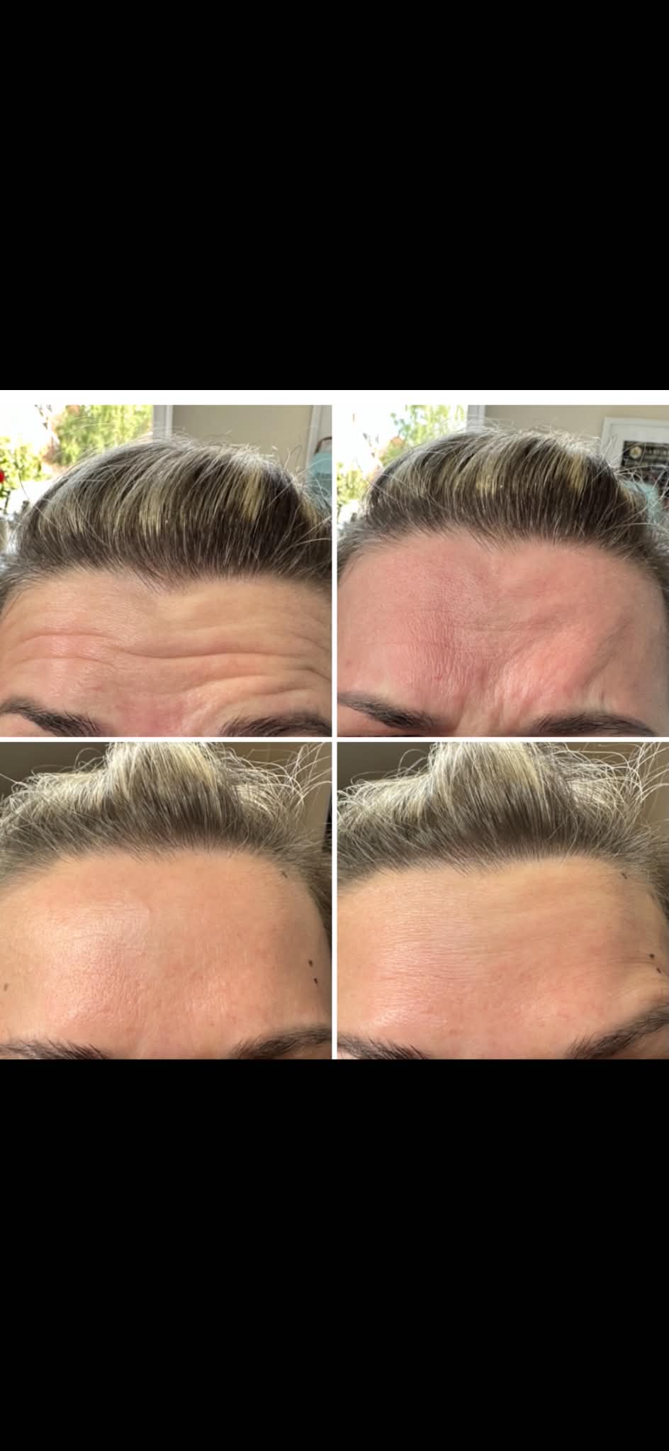 Before and after results of Botox anti-wrinkle injections showing significantly reduced forehead lines at Gingerbread Aesthetic