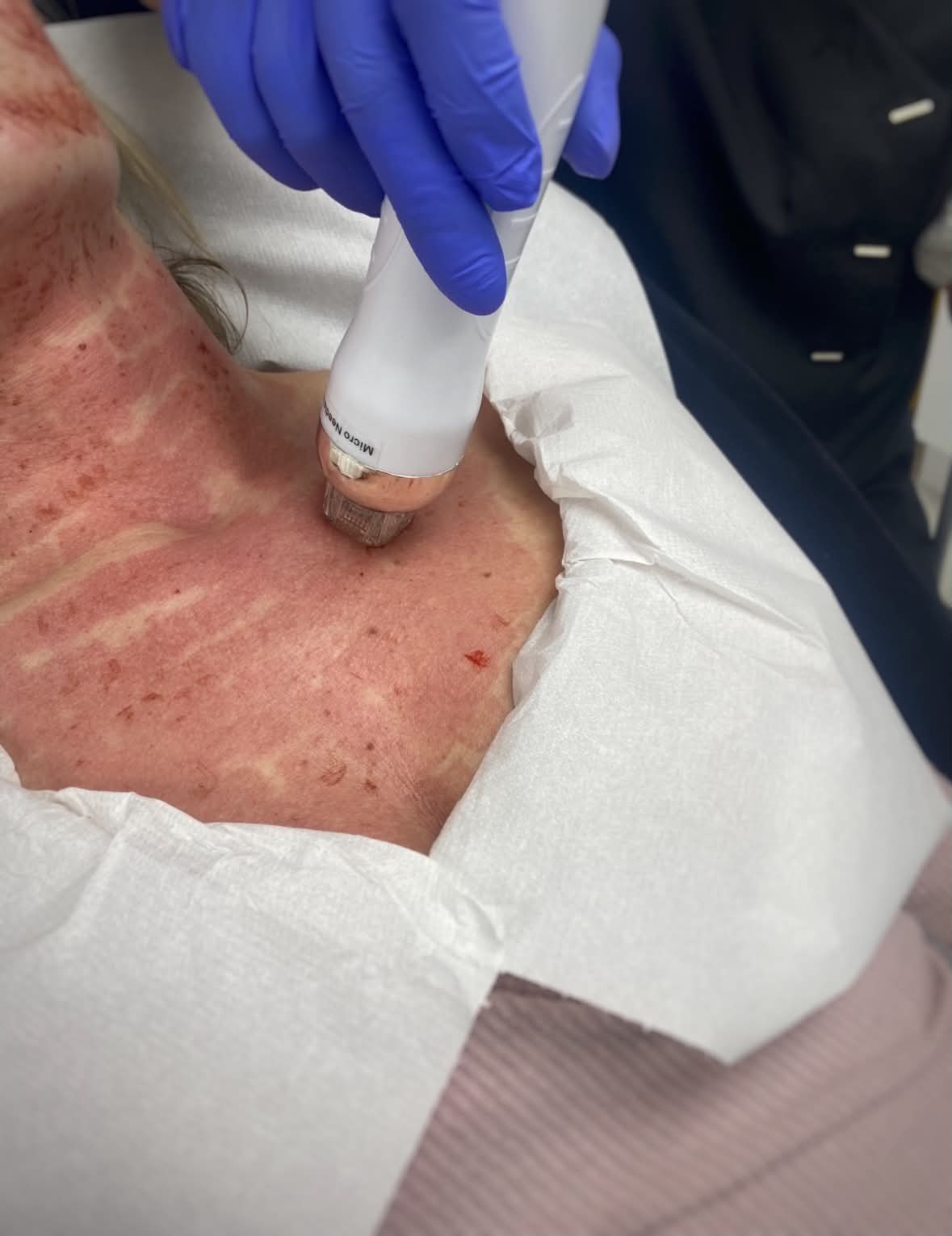 RF Microneedling treatment being performed on a client at Gingerbread Aesthetic, Towcester — radiofrequency microneedling for skin tightening and collagen stimulation