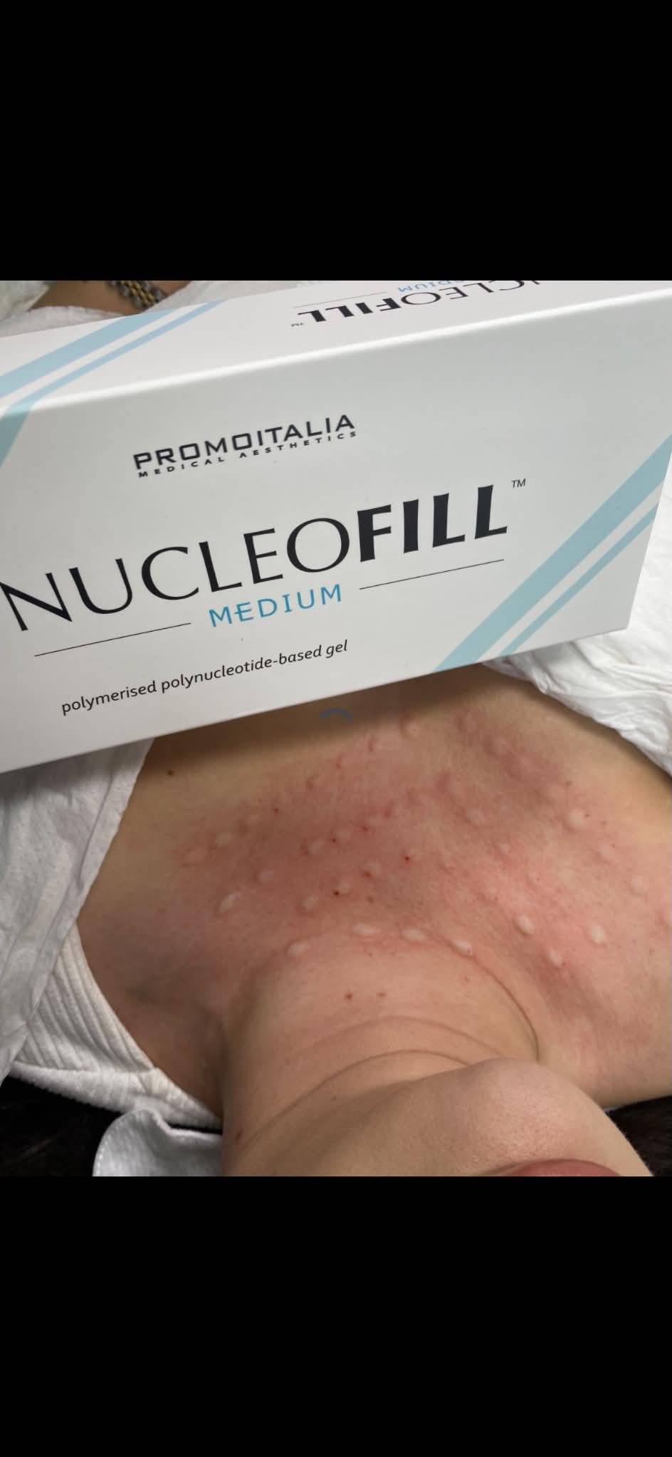Nucleofill polynucleotide biostimulator by Promoitalia — a premium injectable product used in mesotherapy treatments at Gingerbread Aesthetic, Towcester